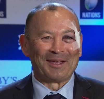 Eddie Jones and his black eye